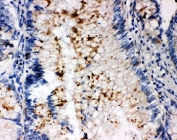 IHC-P: SSX2 antibody testing of human intestinal cancer tissue