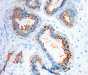 IHC-P: CXCR4 antibody testing of human mammary cancer tissue.
