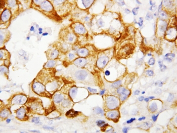 IHC-P: TNFR2 antibody testing of human breast cancer tissue