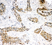 IHC-P: Caspase-3 antibody testing of human lung cancer tissue