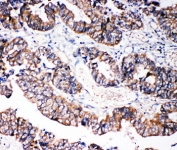 IHC-P: Caspase-3 antibody testing of human intestinal cancer tissue