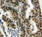 IHC-P: TNFAIP1 antibody testing of human rectal cancer tissue