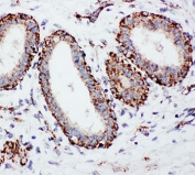 IHC-P: MTCO1 antibody testing of human breast cancer tissue