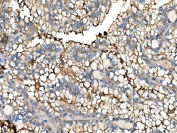 IHC staining of FFPE human tonsil tissue with N-Cadherin antibody. HIER: boil tissue sections in pH8 EDTA for 20 min and allow to cool before testing.