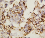 IHC staining of FFPE human ovarian cancer tissue with N-Cadherin antibody. HIER: boil tissue sections in pH6 citrate buffer for 20 min and allow to cool before testing.