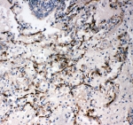 IHC-P: CD34 antibody testing of human lung cancer