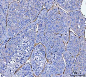 IHC-P: CD34 antibody testing of human liver cancer tissue with CD34 antibody. HIER: boil tissue sections in pH8 EDTA for 20 min and allow to cool before testing.