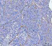 IHC-P: CD34 antibody testing of human liver cancer tissue with CD34 antibody. HIER: boil tissue sections in pH8 EDTA for 20 min and allow to cool before testing.