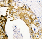 IHC-P: Cytokeratin 19 antibody testing of human oesophagus squama cancer tissue
