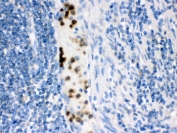 IHC staining of FFPE human intestinal cancer with FABP3 antibody. HIER: boil tissue sections in pH6, 10mM citrate buffer, for 20 min and allow to cool before testing.