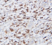 IHC-P: GRP94 antibody testing of human lung cancer tissue. HIER: steamed with pH6 citrate buffer.
