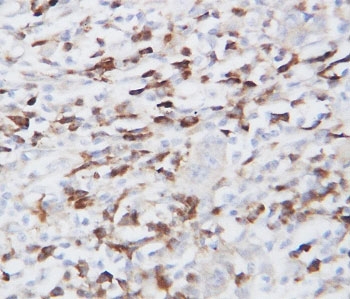 IHC-P: GRP94 antibody testing of human lung cancer tissue