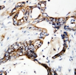 IHC-P: uPAR antibody testing of human breast cancer tissue.