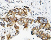 IHC-P: SOD1 antibody testing of human breast cancer tissue