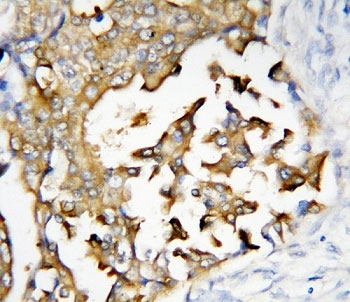 IHC-P: Presenilin 2 antibody testing of human breast cancer tissue