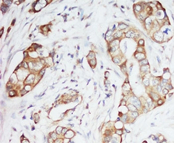 IHC-P: IGF-1 antibody testing of human breast cancer tissue