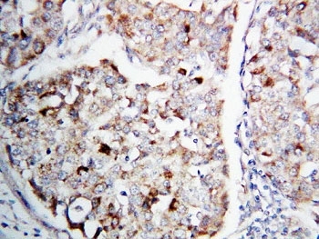 IHC-P: MEK1 antibody testing of human lung cancer tissue