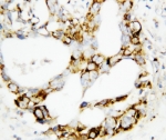 IHC-P: MEK3 antibody testing of human breast cancer tissue