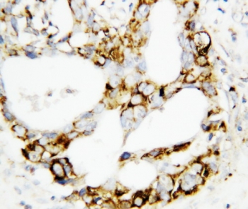 IHC-P: MEK3 antibody testing of human breast cancer t