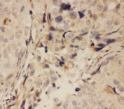 IHC testing of FFPE human breast cancer tissue with RANK antibody at 1ug/ml. Required HIER: steam section in pH6 citrate buffer for 20 min and allow to cool prior to tetsting.