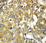 IHC-P: Pleiotrophin antibody testing of human breast cancer tissue