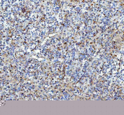IHC staining of FFPE human glioma tissue with Pleiotrophin antibody, HRP-labeled secondary and DAB substrate. HIER: boil tissue sections in pH8 EDTA for 20 min and allow to cool before testing.