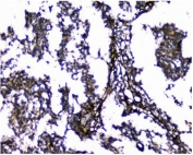 IHC staining of FFPE human glioma with Galectin antibody. HIER: boil tissue sections in pH8 EDTA for 20 min and allow to cool before testing.