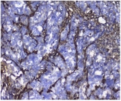 IHC staining of FFPE human stomach cancer with Galectin antibody. HIER: boil tissue sections in pH8 EDTA for 20 min and allow to cool before testing.