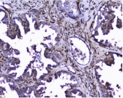 IHC staining of FFPE human ovarian cancer with Galectin antibody. HIER: boil tissue sections in pH8 EDTA for 20 min and allow to cool before testing.