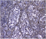 IHC staining of FFPE human liver cancer with Galectin antibody. HIER: boil tissue sections in pH8 EDTA for 20 min and allow to cool before testing.