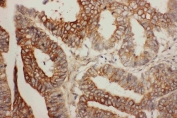 IHC testing of FFPE human rectal cancer tissue with Bcl2L2 antibody at 1ug/ml. Required HIER: steam section in pH6 citrate buffer for 20 min and allow to cool prior to staining.