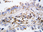 IHC-P: CXCL9 antibody testing of human lung cancer tissue. HIER: steamed with pH6 citrate buffer.