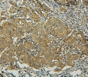 IHC staining of FFPE human breast cancer with BAK antibody. HIER: boil tissue sections in pH8 EDTA for 20 min and allow to cool before testing.