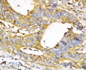 IHC-P testing of human breast cancer tissue