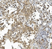 IHC staining of FFPE human pancreatic cancer tissue with Caspase-6 antibody. HIER: boil tissue sections in pH8 EDTA for 20 min and allow to cool before testing.