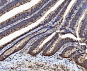 IHC staining of FFPE human colorectal adenocarcinoma tissue with Caspase-6 antibody. HIER: boil tissue sections in pH8 EDTA for 20 min and allow to cool before testing.