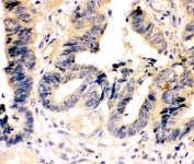 IHC-P: Caspase-7 antibody testing of human intestinal cancer tissue. HIER: steamed with pH6 citrate buffer.