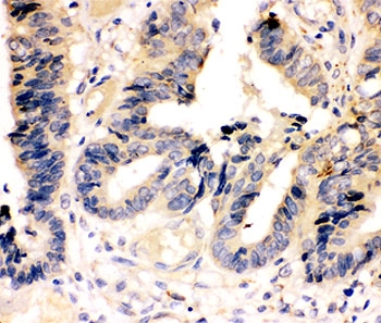 IHC-P: Caspase-7 antibody testing of human intestinal cancer tissue