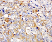 IHC-P: CXCL4 antibody testing of human lung cancer tissue