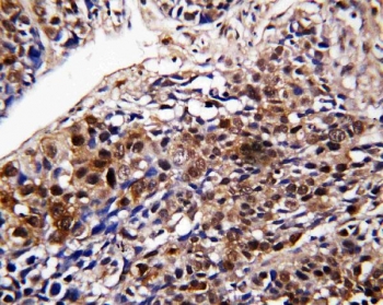 IHC staining of FFPE human lung cancer tissue with DDT antibody. HIER: boil tissue sections in pH6, 10mM citrate buffer, for 20 min and allow to cool before testing.~