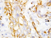IHC-P: beta Defensin 1 antibody testing of lung cancer tissue