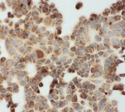 ICC staining of FFPE human MCF7 cells with Lipoamide Dehydrogenase antibody. HIER: steam section in pH6 citrate buffer for 20 min.