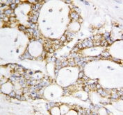 IHC staining of FFPE human breast cancer tissue with Lipoamide Dehydrogenase antibody. HIER: boil tissue sections in pH6 citrate buffer for 20 min and allow to cool before testing.