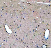 IHC staining of FFPE human lung cancer with GDNF antibody. HIER: boil tissue sections in pH6, 10mM citrate buffer, for 20 min and allow to cool before testing.