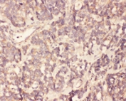 IHC testing of FFPE human gallbladder cancer tissue with FGF19 antibody at 1ug/ml. HIER: steam section in pH6 citrate buffer for 20 min.