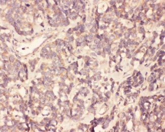 IHC testing of FFPE human gallbladder cancer tissue with FGF19 antibody at 1ug/ml. HIER: steam section in p