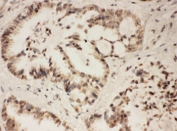 IHC testing of FFPE human lung cancer tissue with FGFR1 antibody at 1ug/ml. HIER: steam section in pH6 citrate buffer for 20 min.
