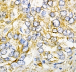 IHC-P: AIMP2 antibody testing of human rectal cancer tissue