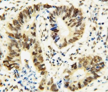IHC-P: MTA1 antibody testing of human rectal cancer tissue
