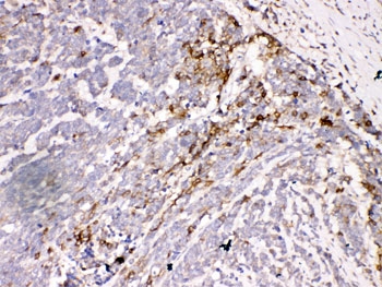 IHC-P: AQP3 antibody testing of human lung cancer tissue. HIER: Boil the paraffin sections in 10mM citrate buffer, pH6, for 20 mins.
